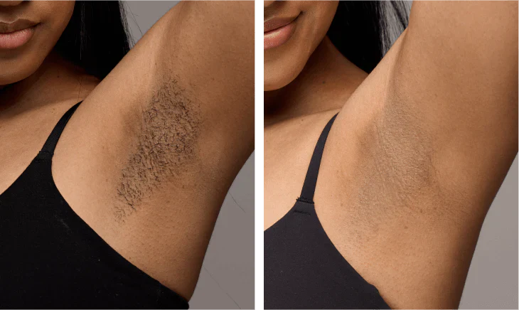 Before and after result