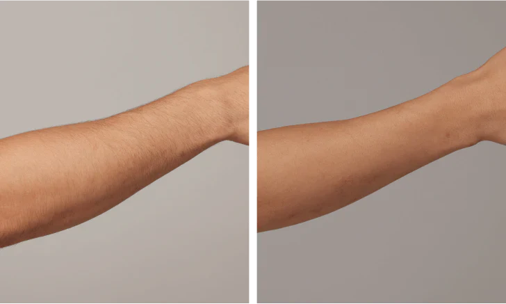 Before and after result