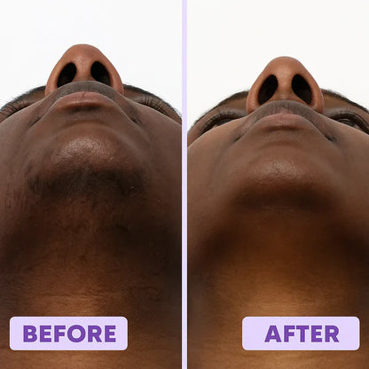 PCOS Facial Hair Removal Cream | Chin Hair Remover for Women