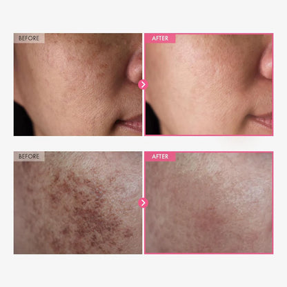 Acne Dark Spot Cream | Korean Brightening Cream for Post-Acne Marks