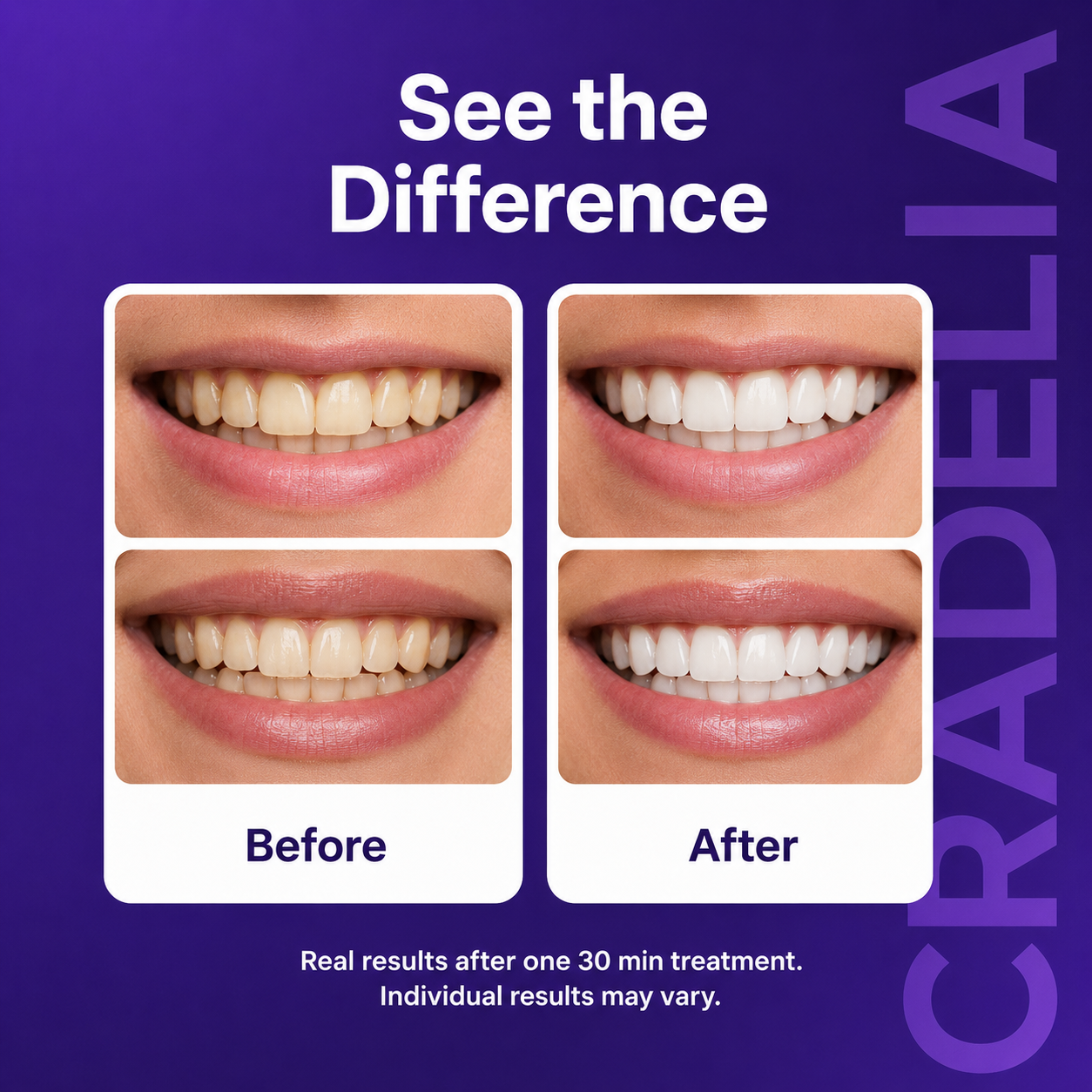 Purple Teeth Whitening Strips | Peroxide-Free PAP Whitening Strips for Whiter Teeth