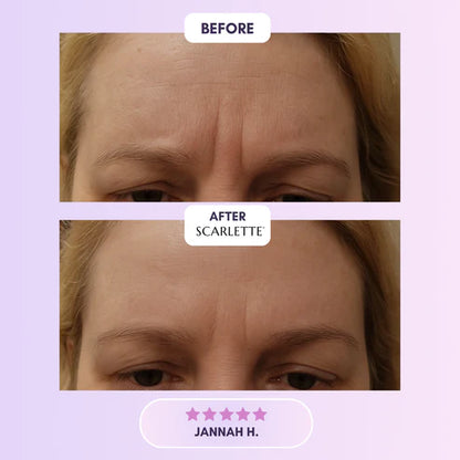 Silicone Collagen Sheets for Scars & Wrinkles