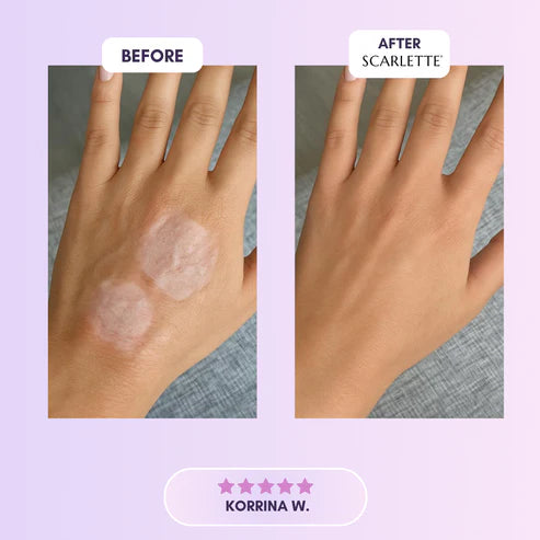 Silicone Collagen Sheets for Scars & Wrinkles