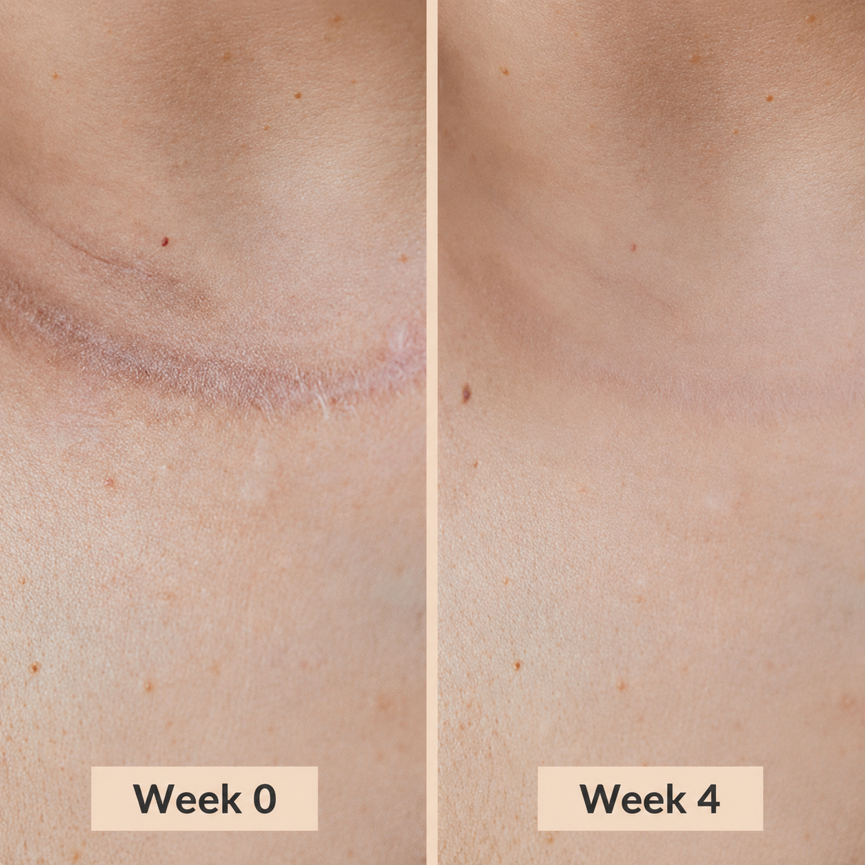 Silicone Scar Stick