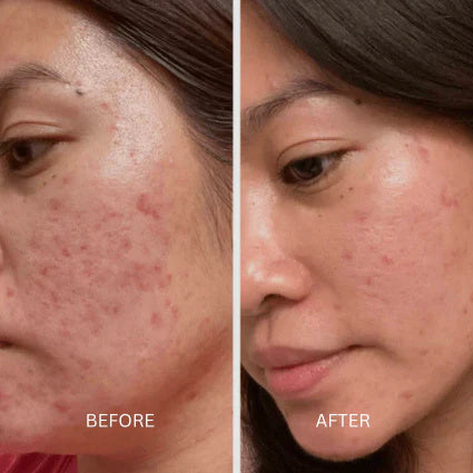 Before and after skin result