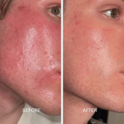 Before and after skin result